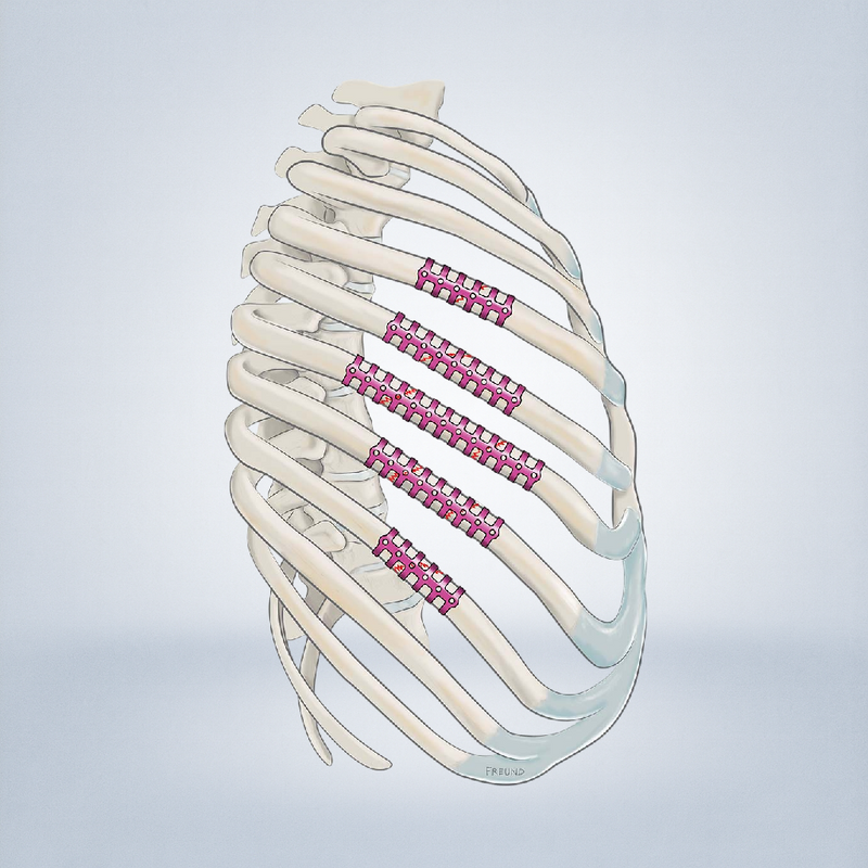 Clip Costales y Esternales